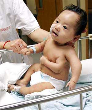 Cháu bé Jie-jie, 59 ngày tuổi được sinh ra tại Bệnh viện Thượng Hải với dị tật bẩm sinh có ba tay