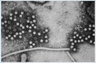 Virus gây viêm gan siêu vi E