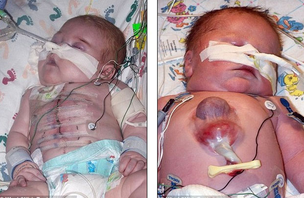 Từ trái qua phải: cậu bé Ryan sau khi phẫu thuật và trước khi phẫu thuật với trái tim ngoài cơ thể
