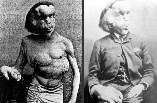 Joseph Merrick đã dũng cảm sống với thân phận “người voi” 