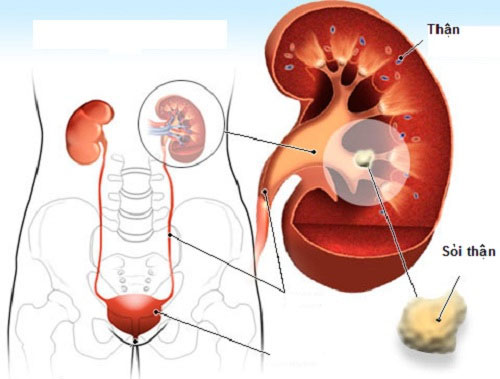 Sỏi thận là một trong những nguyên nhân dẫn đến suy thận Tất cả những điều bạn cần biết về bệnh sỏi thận