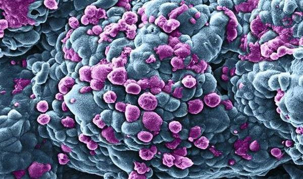 Các nhà khoa học Italy tìm ra cơ chế di căn ở bệnh ung thư vú