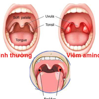 Tìm hiểu về viêm Amidan và thời điểm thích hợp cắt Amidan