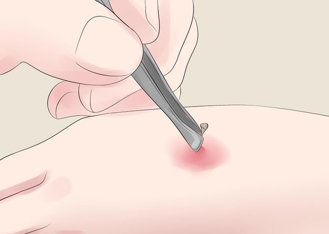 Dùng nhíp lấy ngòi chích của ong ra Dùng nhíp lấy ngòi chích của ong ra