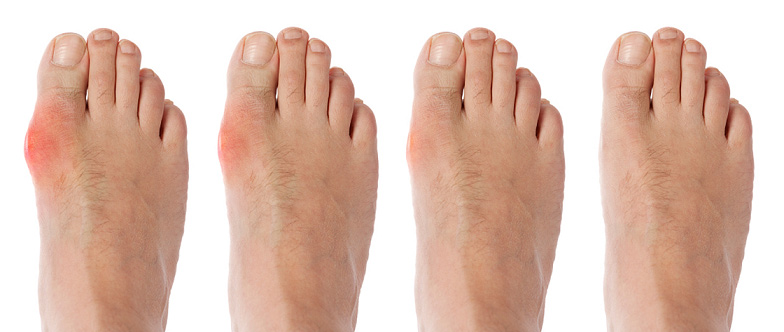 Bệnh gout nằm trong nhóm bệnh lắng tụ tinh thể (crystalline deposition disease).