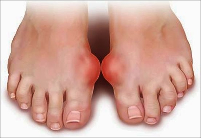 Dấu hiệu của bệnh gout