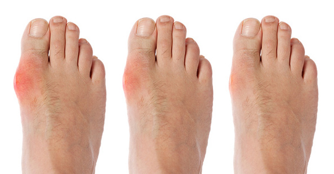 Bệnh gout đến từ đâu?