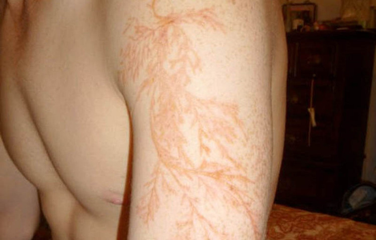 Những vết sẹo trên da sau khi bị sét đánh.