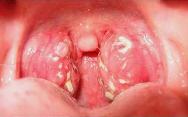 Một lượng nhỏ canxi oxalat cũng đủ gây ngứa, rát trong miệng và cổ họng, sưng tấy và ngạt thở.
