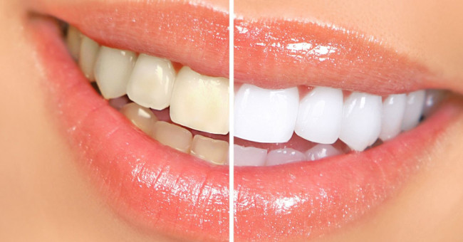 16 cách làm răng trắng hơn