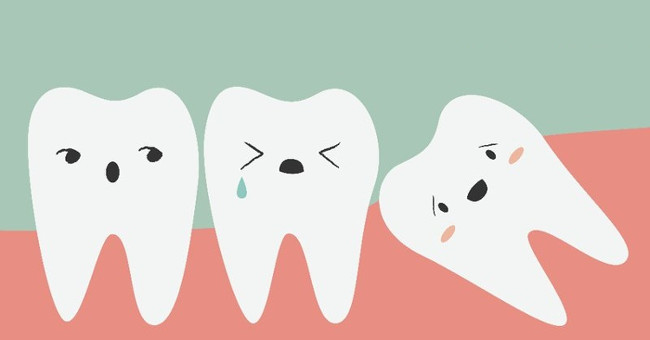 Loại bỏ suy nghĩ sai lầm về việc nhổ răng khôn
