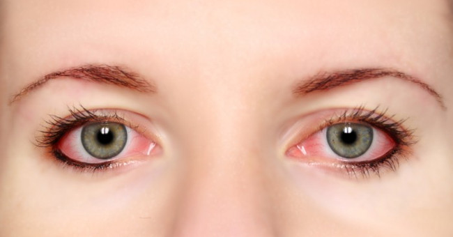 Những điều "không thể không biết" về bệnh đau mắt đỏ