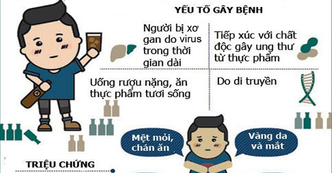 Dấu hiệu nhận biết và tránh ung thư gan