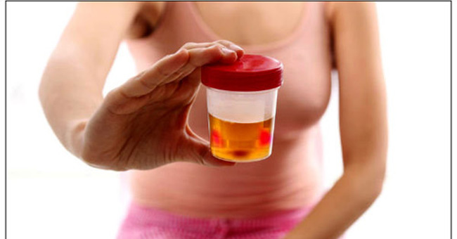 Ung thư bàng quang rất đáng sợ, chị em nhất định phải biết các dấu hiệu này