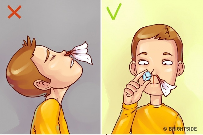 Khi chảy máu cam, bạn nên giữ đầu thẳng để máu chảy xuôi xuống, chườm lạnh ngăn máu chảy nhiều. Khi chảy máu cam, bạn nên giữ đầu thẳng để máu chảy xuôi xuống, chườm lạnh ngăn máu chảy nhiều.