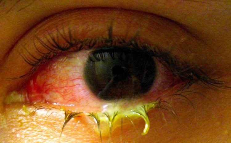 Đôi mắt chúng ta tồn tại 1 cộng đồng vi khuẩn, có thể bảo vệ ta tránh khỏi bệnh tật.