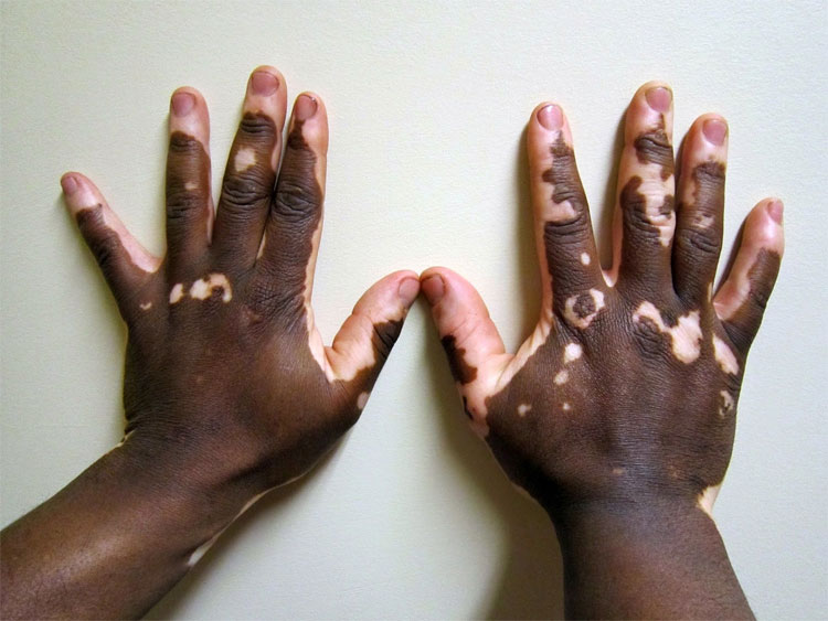 Bệnh Vitiligo