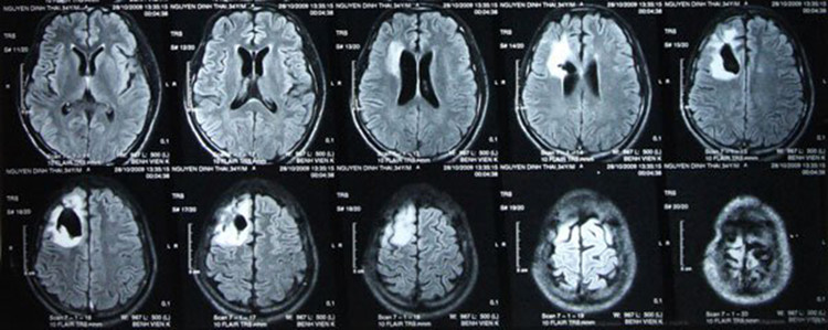 Phim chụp cắt lớp CT.