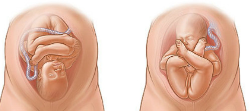 Thai nhi bình thường và thai ngôi mông (bên phải).