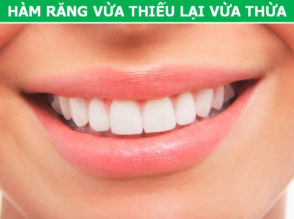 Hàm răng của con người lại có một vài chiếc răng không thực sự cần thiết, đáng nói nhất chính là răng Khôn.
