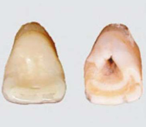 Răng sữa bình thường (trái) và răng sữa hình xẻng (phải).
