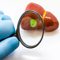 Bệnh polyp túi mật - Nguyên nhân, triệu chứng và cách điều trị Bệnh polyp túi mật - Nguyên nhân, triệu chứng và cách điều trị