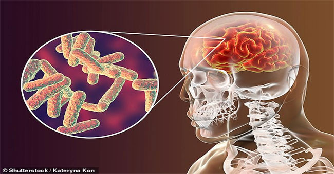 Giải mã những hiểu lầm về bệnh viêm màng não