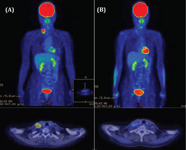 Mô hình chụp PET/CT của bệnh viện Ung bướu Hà Nội.