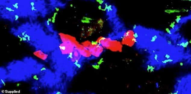 Các tế bào T (màu xanh lá cây) nằm đan xen các tế bào ung thư (màu đỏ) và da lành (màu xanh)