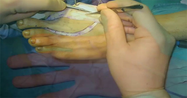 Việt Nam thực hiện thành công phẫu thuật siêu khó: lấy ngón chân cái thay cho ngón tay cái