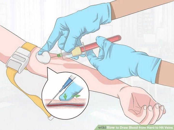 Kết thúc quá trình lấy máu, y tá hoặc bác sĩ thường chèn bông có tẩm cồn ngay vào vị trí rút ống tiêm. 