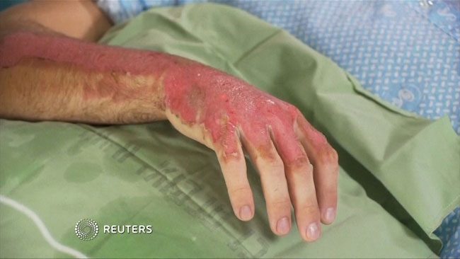 Vết bỏng trên cánh tay và mu bàn tay của bệnh nhân Rottenberg.