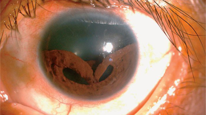 Hiện tượng này xảy ra khi mắt bị va đập mạnh, thường gặp trong các chấn thương thể thao...