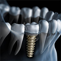Cấy ghép răng implant là gì? Cấy ghép răng implant là gì?