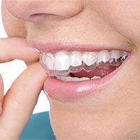 Những điều chưa biết về niềng răng trong suốt Invisalign Những điều chưa biết về niềng răng trong suốt Invisalign