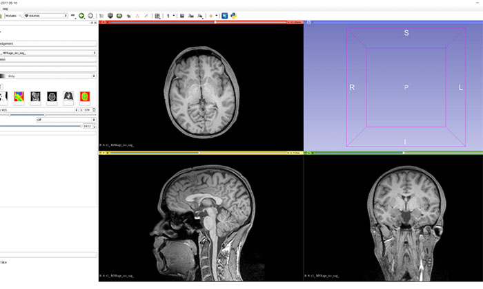  Dữ liệu MRI và chụp CT sẽ tự động chuyển đổi sang hình chiếu 3D.