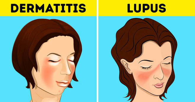 Lupus với các bệnh khác