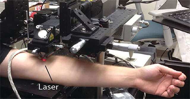 Công nghệ laser mới có thể tiêu diệt tế bào ung thư hắc tố