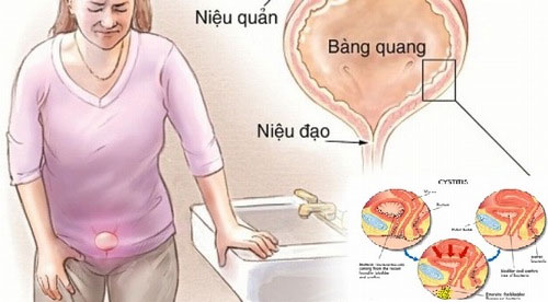 Bệnh nhiễn trùng đường niệu có thể gây ra những cơn đau đột ngột ở phần vùng bụng dưới bên trái.