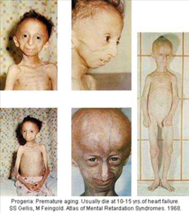 Cơ thể của một bệnh nhân mắc Progeria.