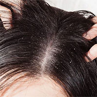 Gàu là bệnh gì? Gàu là bệnh gì?