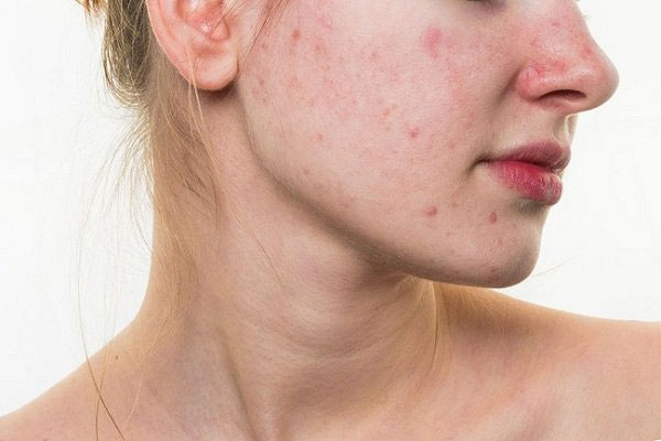 Dị ứng da mặt ảnh hưởng nghiêm trọng đến cuộc sống.