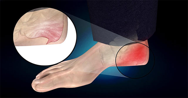 Bệnh gai xương gót là gì?