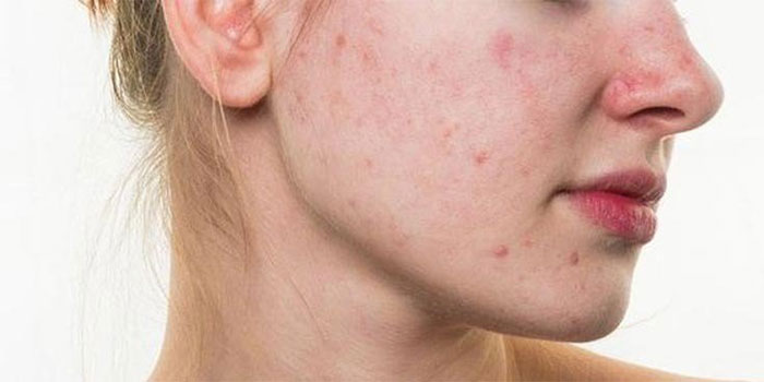 Hãy đến bác sĩ da liễu để bạn có được lời khuyên tốt nhất trong việc điều trị làn da sần sùi.
