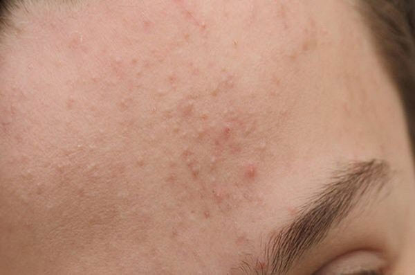 Đặc biệt vào những mùa khô hanh, những bạn sở hữu làn da khô rất dễ gặp phải tình trạng này.