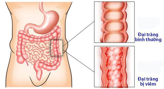 Sự khác biệt giữa đại tràng khỏe mạnh và đại tràng bị viêm.