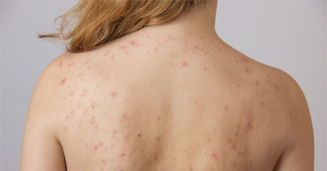 Lưng mọc nhiều mụn có thể là biểu hiện của 4 vấn đề sức khỏe sau
