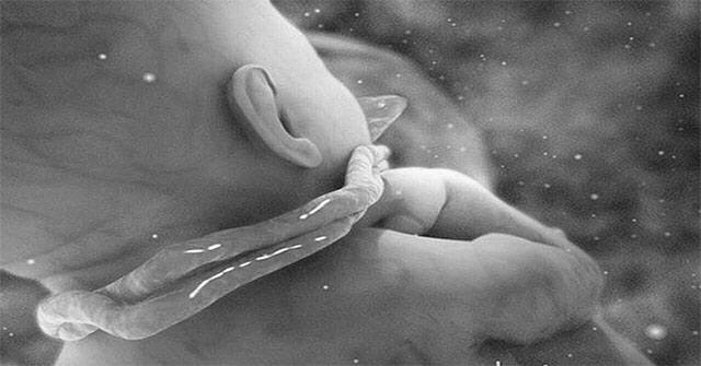 Hiện tượng dây rốn quấn cổ thai nhi là gì?