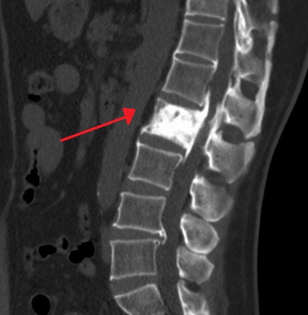 Hình ảnh chụp X-quang xương của một bệnh nhân mắc bệnh Paget.