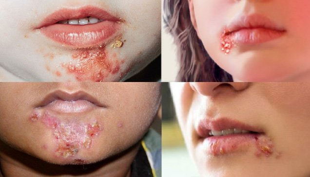 Giai đoạn bệnh chuyển sang thể ecthyma.